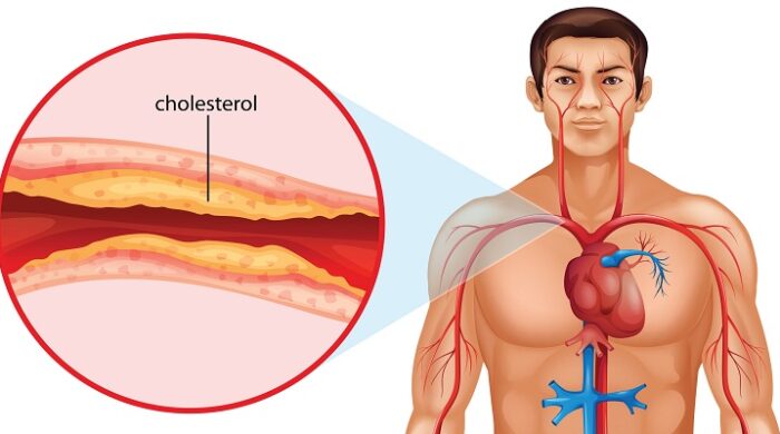 কোলেস্টেরল কম হলেও কি হৃদরোগের ঝুঁকি শূন্য?