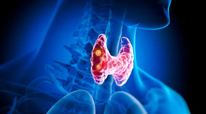 জীবনযাপনের যেসব ভুলে নীরবে বাড়ে থাইরয়েড ঝুঁকি