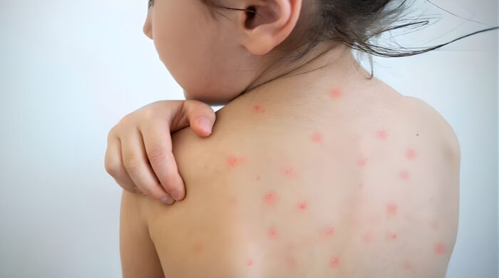 শিশু হাম প্রতিরোধ করণীয়