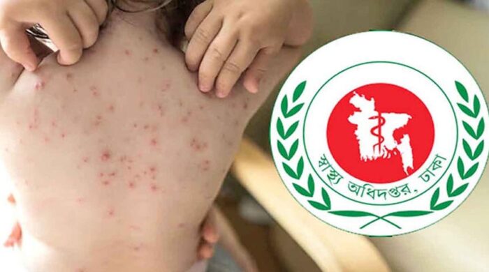 দেশে হামের সংক্রমণ বৃদ্ধি