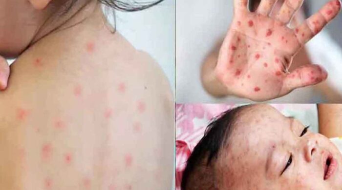 হাম: ঝুঁকিতে অপুষ্ট শিশুরা