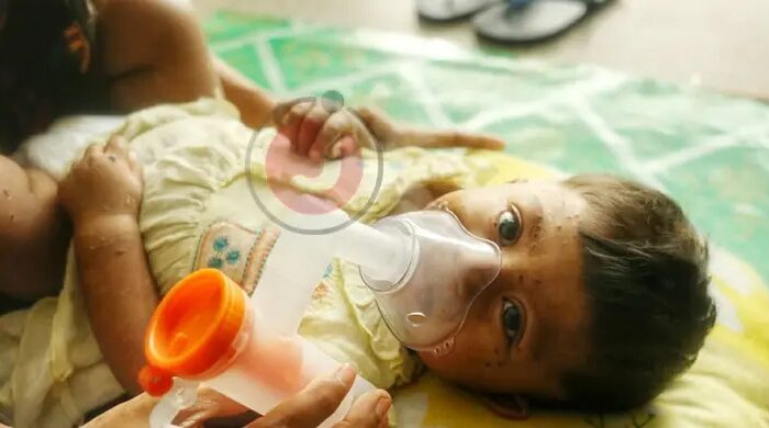 হাম সংক্রমণ শিশু আপডেট