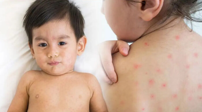 হাম সংক্রমণ প্রতিরোধ সতর্কতা