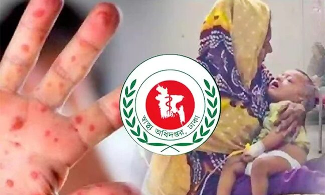 দেশে হামের সংক্রমণ বৃদ্ধি, শিশুস্বাস্থ্যে নতুন উদ্বেগ