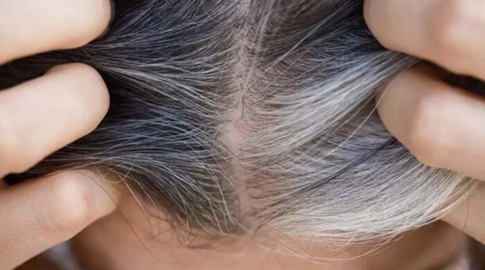 অল্প বয়সে চুল পাকা