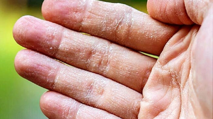 গরমে হাতের চামড়া উঠছে