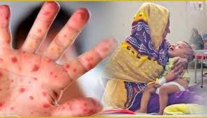 হামে আক্রান্ত হয়ে ২ শিশুর মৃত্যু
