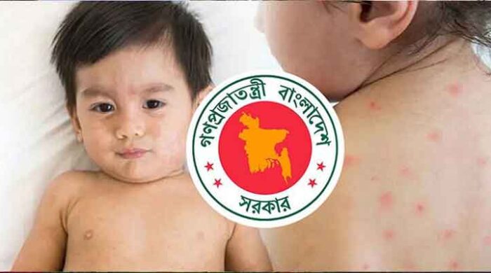 হাম উপসর্গে আরও ৬ শিশুর মৃত্যু