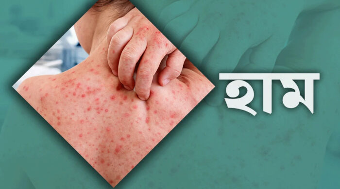 হামে মৃত শিশুদের ৯২ শতাংশই টিকা নেয়নি